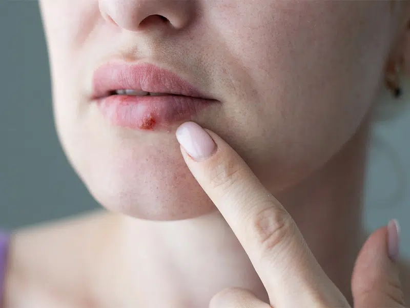 Esszenciális aminosav a vírusok ellen: miért nélkülözhetetlen a lizin 1 lizin